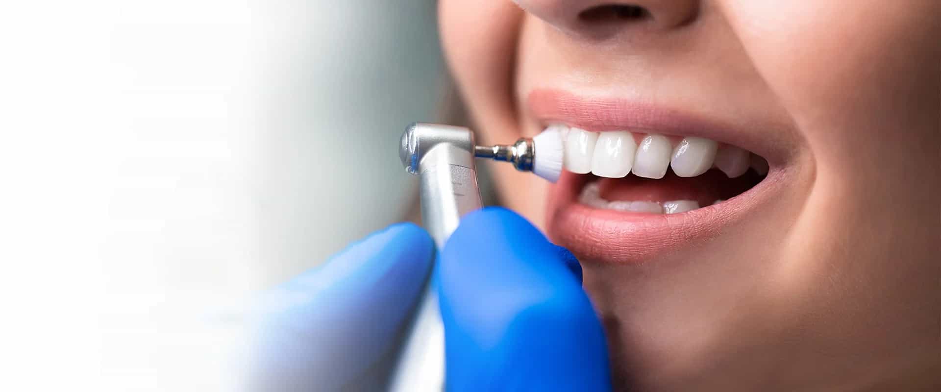 Teeth Cleaning in Dubai - DentalZorg Dental Cleaning Services Near Me