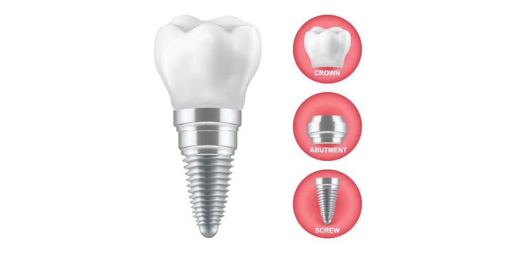 Best Age for Dental Implants