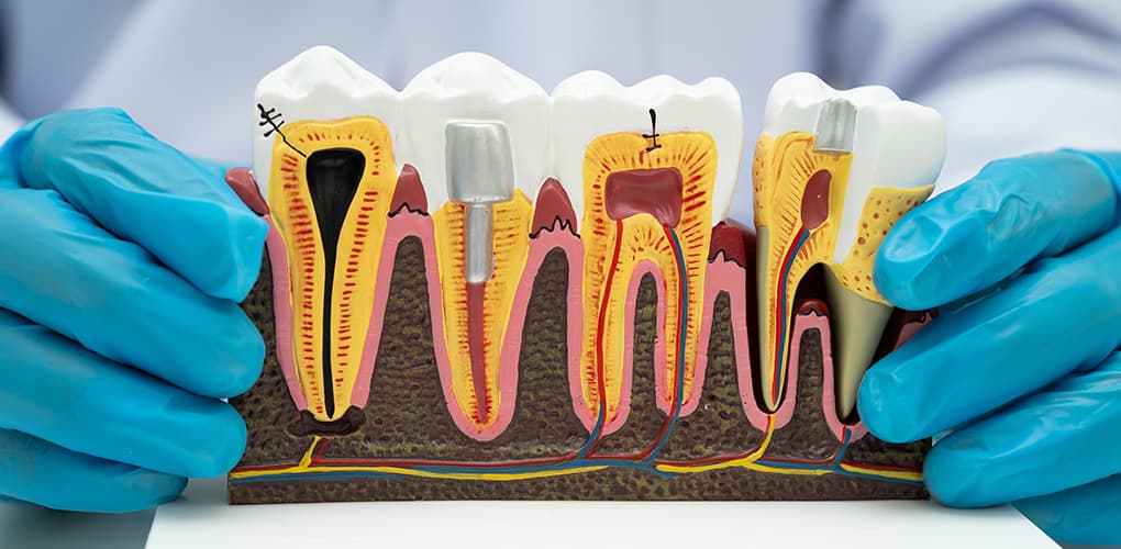 Root Canal Treatment Guide