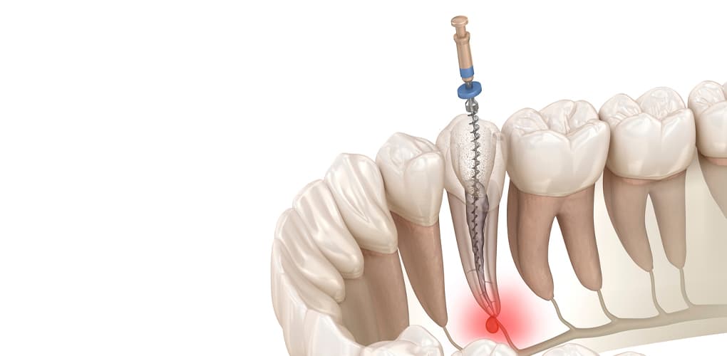 Root Canal Treatment
