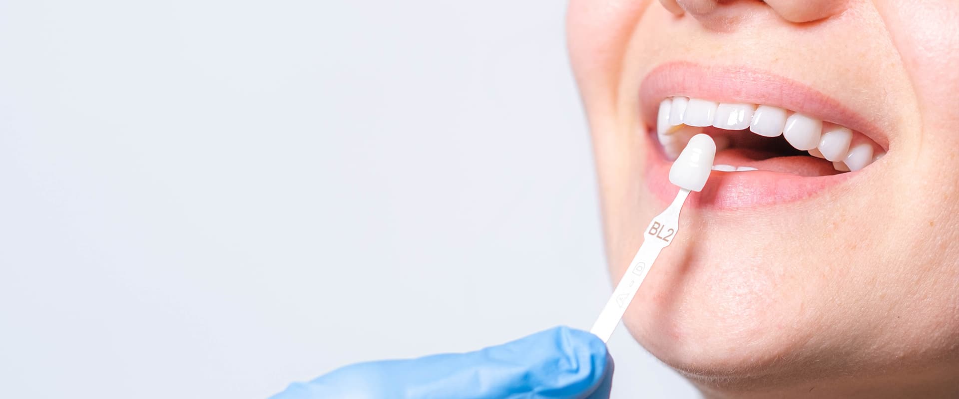 Teeth Veneers