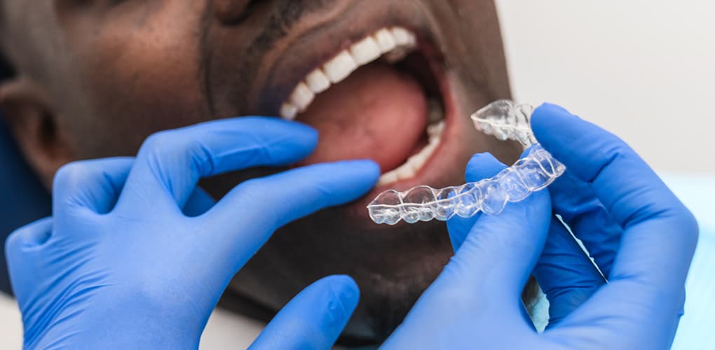 Clear Aligners