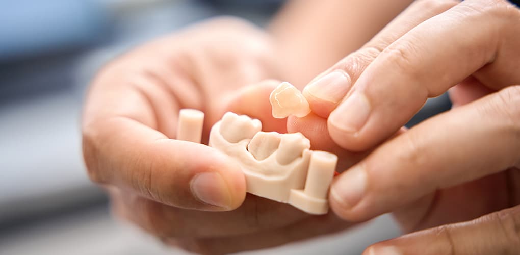 Dental Crowns