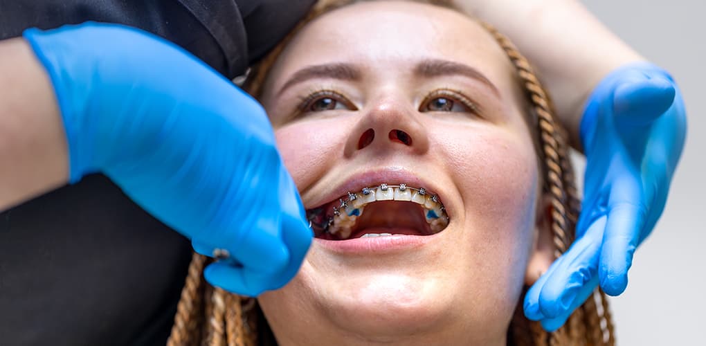 What are the Benefits of Dental Braces?