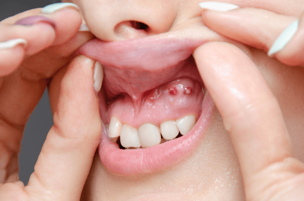 Oral Cysts