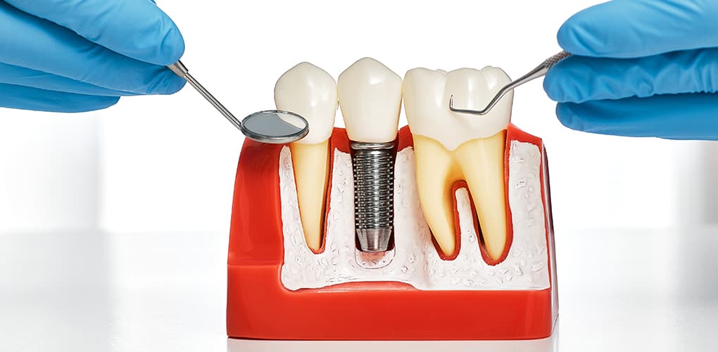 Affordable Dental Implants in Dubai