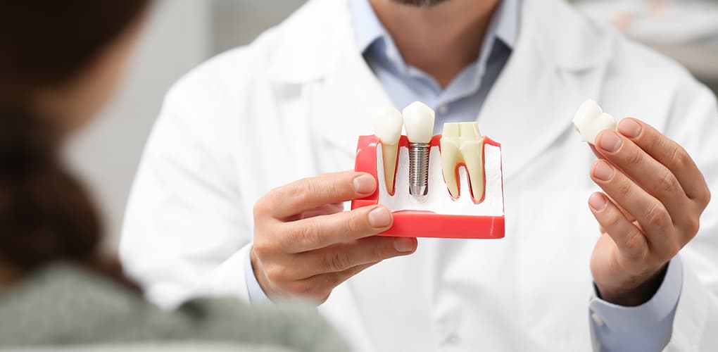 Dental Implants Cost in Dubai