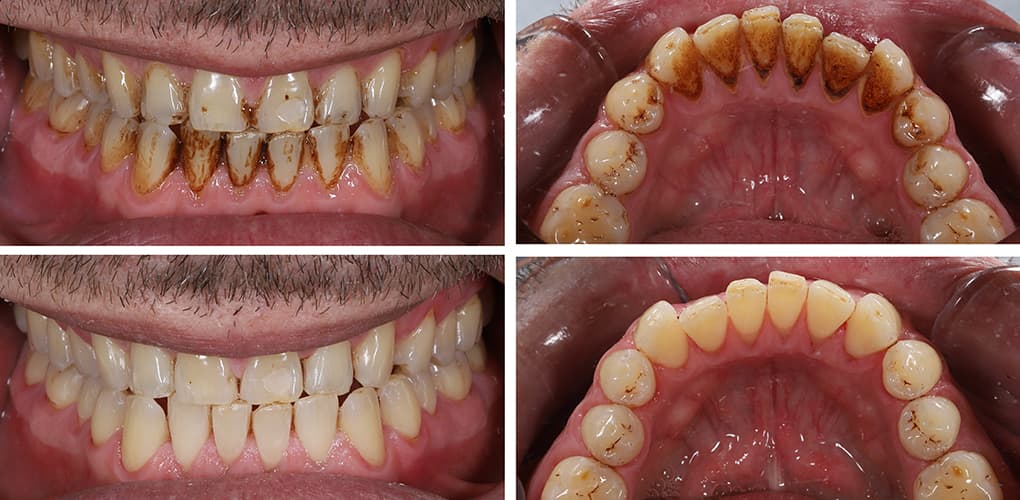 Plaque on Teeth Over Time? Here’s How to Remove It Safely