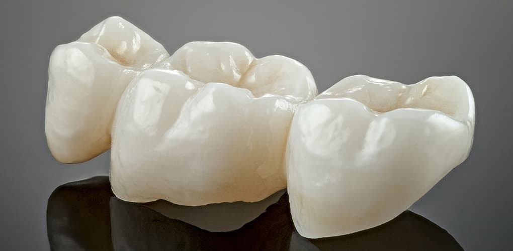 Dental Bridges In Dubai