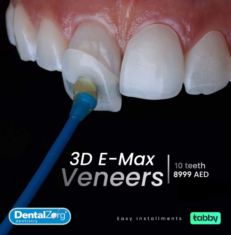 Veneers 10 teeth 8999AED 19 Jan 2023_